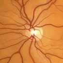 Glaucoma Center