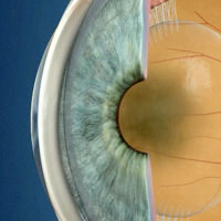 Cataracts