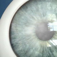 Corneal Transplant