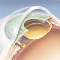 Lens Implants